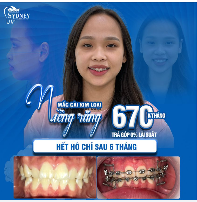 NIỀNG RĂNG CÓ HẾT HÔ KHÔNG ?