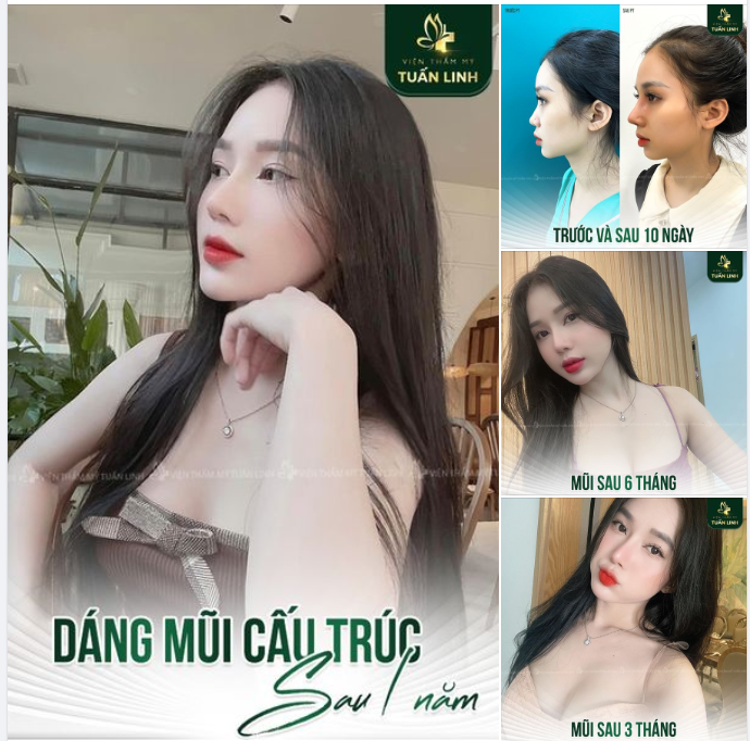 Cận cảnh dáng mũi cấu trúc sau 1 năm - Đẹp tự nhiên đầy sắc nét!