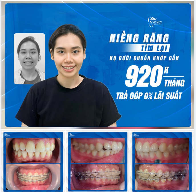NIỀNG RĂNG KHÔNG KHÓ, CHỈ CẦN BẠN ĐỦ QUYẾT TÂM