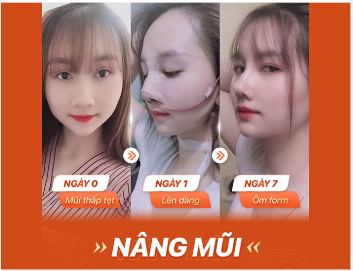 Biến hình siêu xinh sau nâng mũi Perfecet Dform