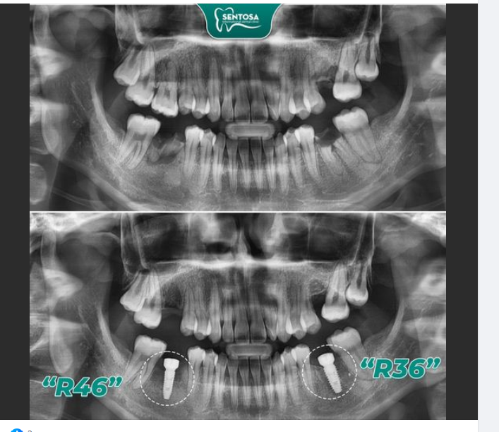 CẤY GHÉP IMPLANT LỰA CHỌN ĐÚNG ĐẮN CHO VIỆC MẤT RĂNG KHI CÒN TRẺ