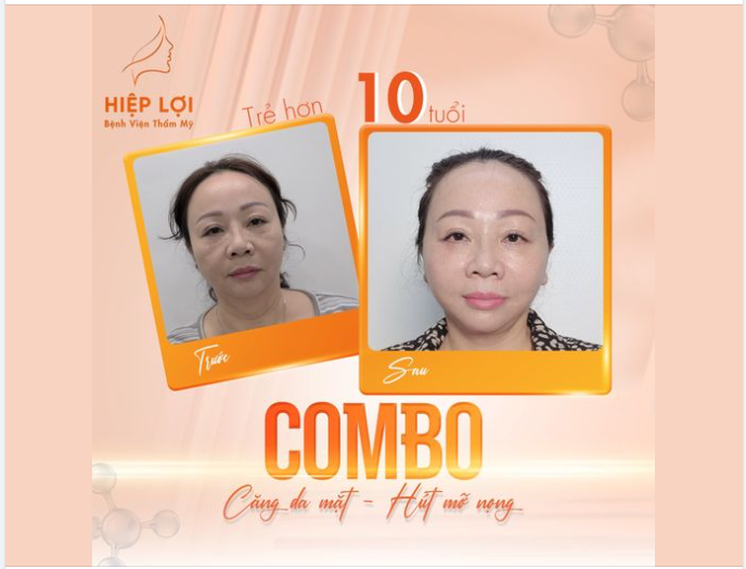 CĂNG DA MẶT XONG SẼ TRÔNG NHƯ THẾ NÀO?