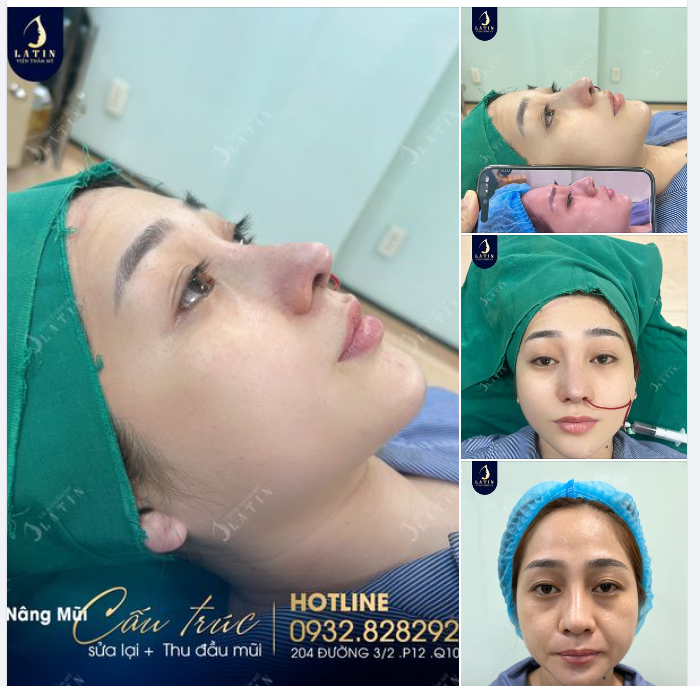 MŨI CẤU TRÚC SỬA LẠI KẾT HỢP THU ĐẦU MŨI CHO CHỊ GÁI ĐẾN TỪ VŨNG TÀU