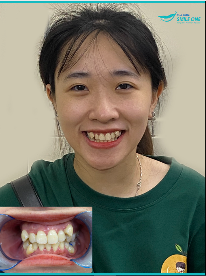 Chào mừng bạn Trần Thị Hồng Ngọc đến với Team niềng răng Smile One!