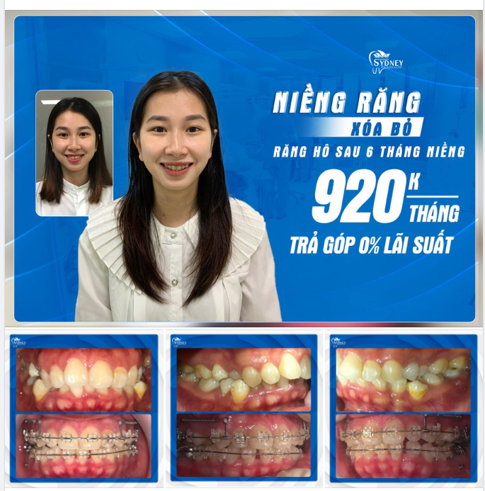 KHUÔN MẶT THAY ĐỔI TÍCH CỰC CHỈ SAU 6 THÁNG NIỀNG RĂNG HÔ