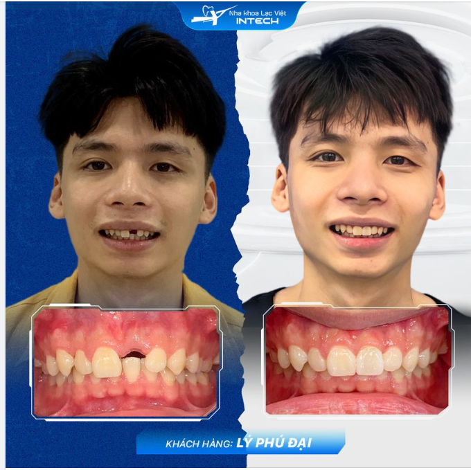 Đâu mới là răng giả?