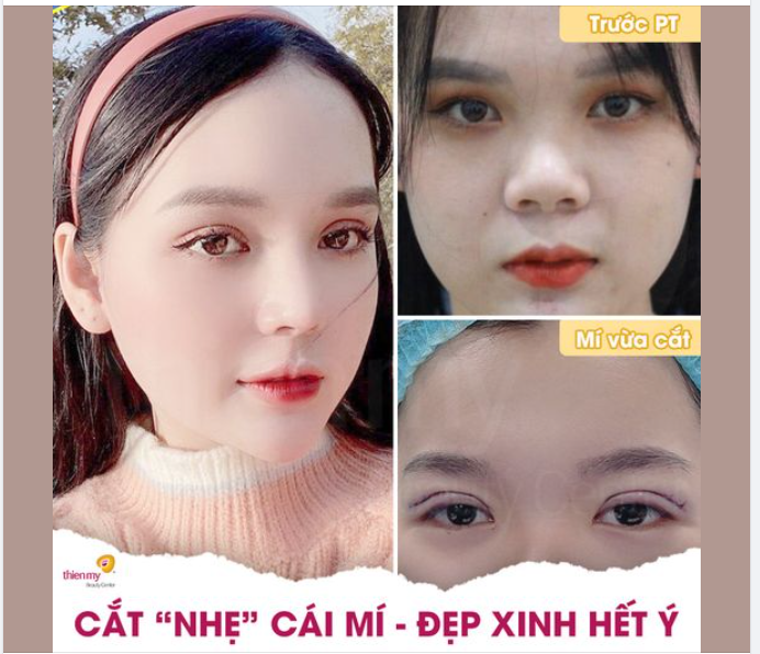 TẠO HÌNH MẮT 2 MÍ VỪA ĐẸP VỪA AN TOÀN