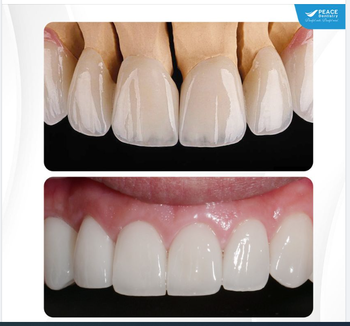 MẶT DÁN SỨ VENEER – GIỮ LẠI TỐI ĐA RĂNG THẬT