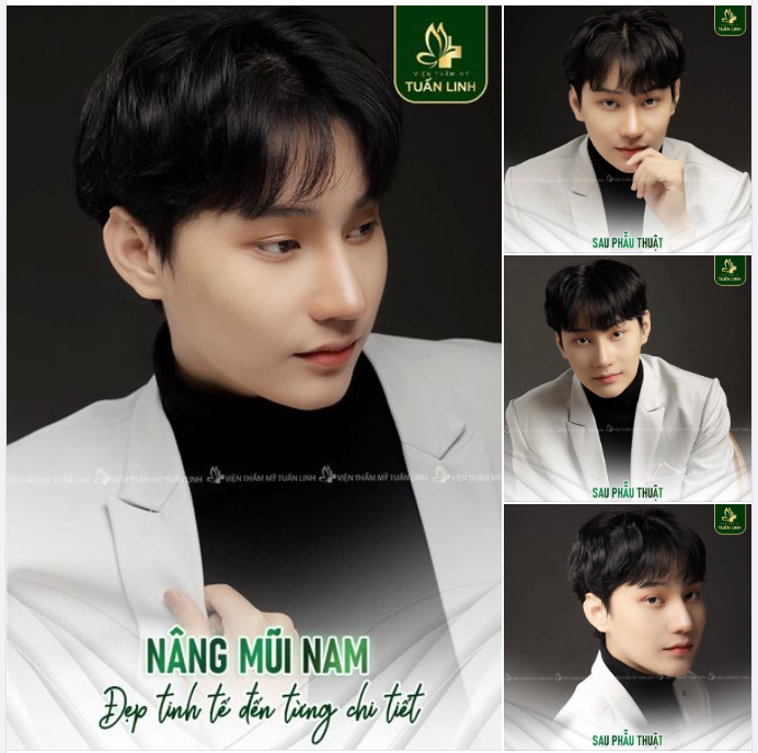 NÂNG MŨI NAM - MŨI ĐẸP TINH TẾ ĐẾN TỪNG CHI TIẾT