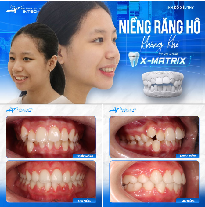 Diệu Thy được niềng răng bằng công nghệ X-Matrix với mắc cài kim loại tự động.