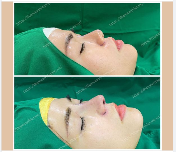 CẬN CẢNH DÁNG MŨI VỪA ĐỘ XONG CHO KH TẠI VTM THIỆN MỸ