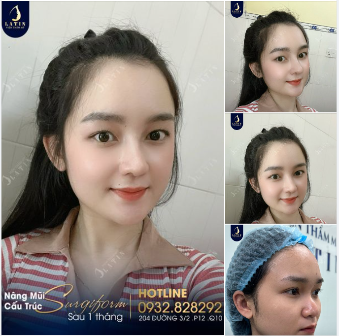 Feedback mũi cấu trúc surgiform 1 tháng tuổi của em gái đến từ Bình Dương.
