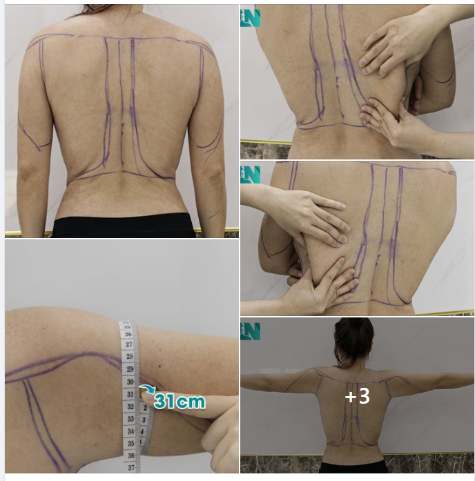 HÚT MỠ TAY LƯNG NÁCH - TRẢ LẠI DÁNG VÓC THUỞ THANH XUÂN