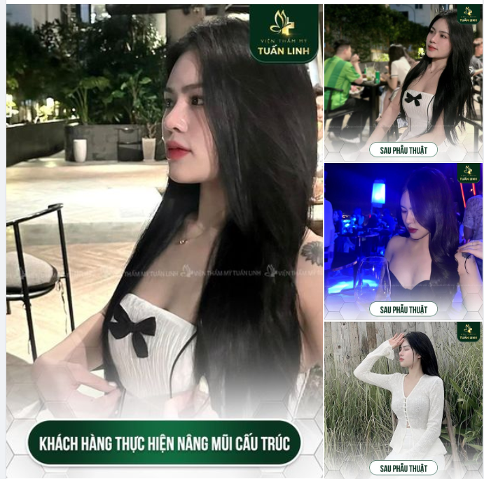 Nâng mũi cấu trúc - Đẹp - Sang - Tự nhiên!!