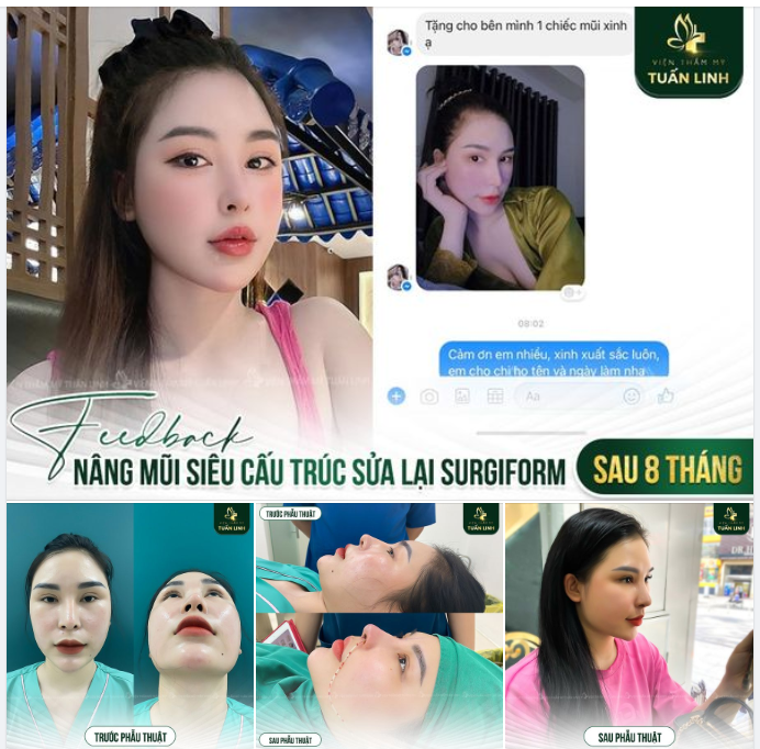 NÂNG MŨI SIÊU CẤU TRÚC GIẢM TỚI 10 TRIỆU