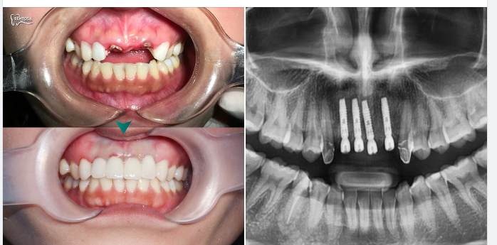 IMPLANT GIẢI QUYẾT TÌNH TRẠNG MẤT NHIỀU RĂNG HOÀN HẢO