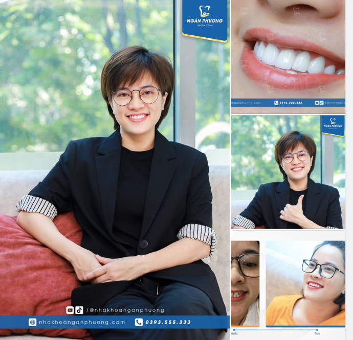 3 năm tái khám, răng sứ Nacera vẫn sáng đẹp long lanh