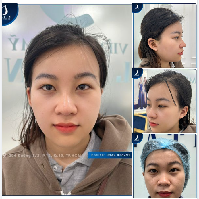 "Nâng mũi xong em thấy mình nữ tính hơn nhiều..."