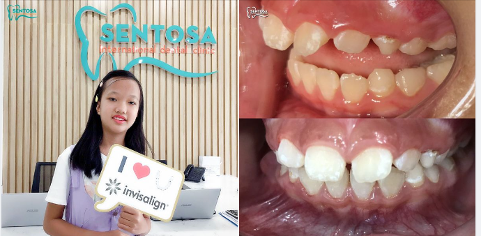 THAY ĐỔI NỤ CƯỜI CỦA CON TỪ KHI CÒN NHỎ VỚI INVISALIGN FIRST