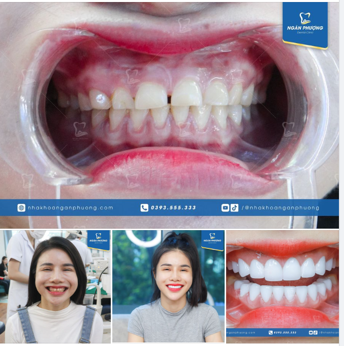 Nghiến răng có hại đến mức nào?
