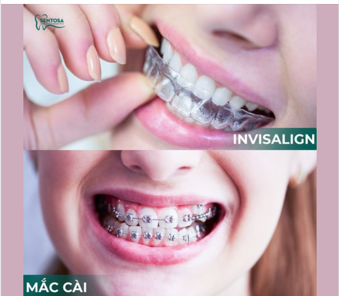 NÊN LỰA CHỌN PHƯƠNG PHÁP NIỀNG RĂNG NÀO