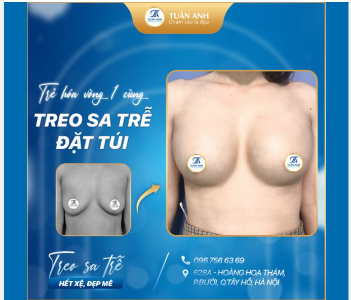 TÁI SINH VÒNG 1 SA TRỄ CHO CHỊ KHÁCH HÀNG U40 ĐẾN TỪ HẢI PHÒNG
