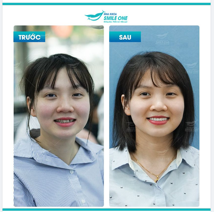 Đến nha khoa Smile One để được các bác sĩ thăm khám miễn phí bạn nhé!