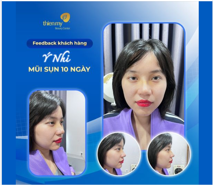Đẹp Thực Sự Luôn - Dáng mũi chị Ý Nhi sau 10 ngày Nâng Mũi Sụn tại VTM Thiện Mỹ!