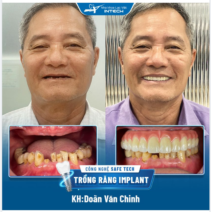 Chú Chinh đến với Nha khoa Lạc Việt Intech trong tình trạng mất răng toàn hàm trên và chú đã từng sử dụng hàm giả tháo lắp