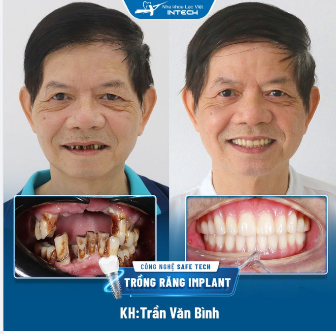 Trồng răng implant xong tôi như được sống lại...