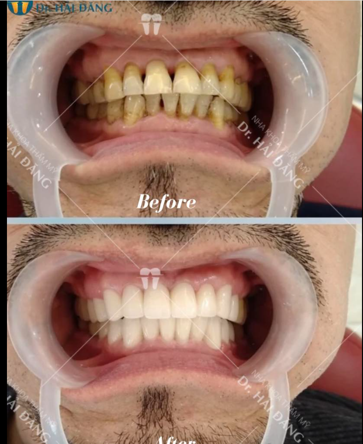 THAY ĐỔI NỤ CƯỜI HOÀN THIỆN CHO KHÁCH HÀNG NAM GIỚI