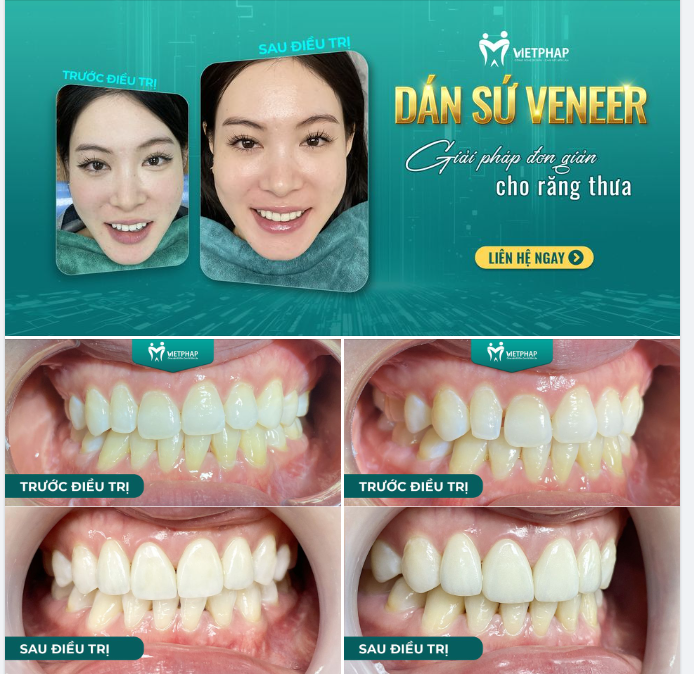 Dán sứ Veneer - Giải pháp đơn giản cho răng thưa