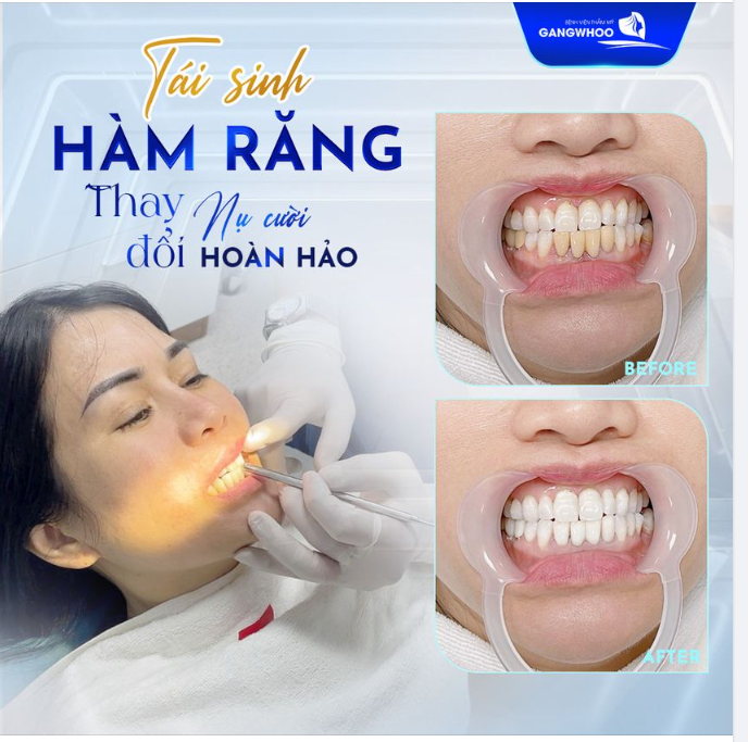 TÁI SINH HÀM RĂNG MỚI - THAY ĐỔI HOÀN TOÀN NỤ CƯỜI CỦA BẠN