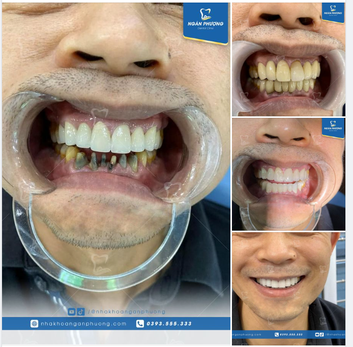 Làm lại răng sứ cho anh khách sau "vấp ngã" 5 năm tại nước ngoài.