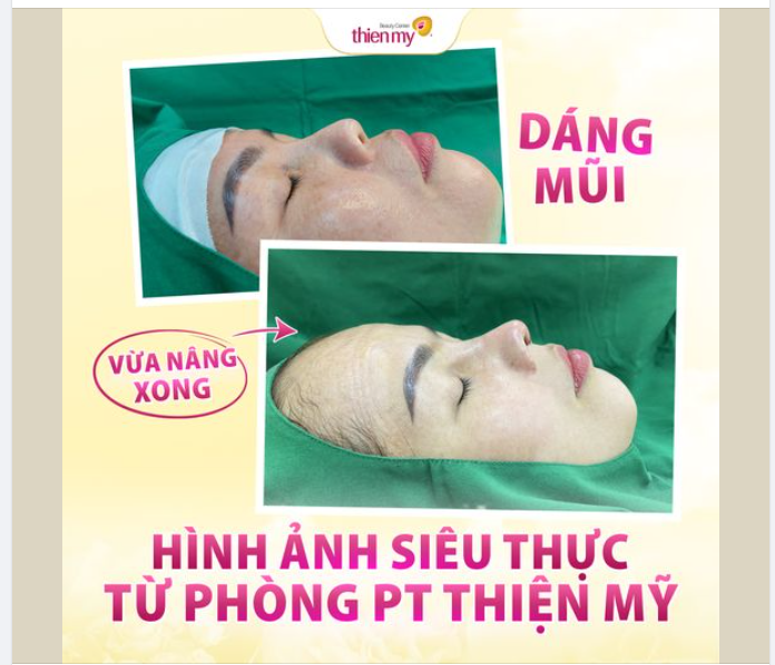 MŨI SANG – CHUẨN TỈ LỆ VÀNG SAU 60P