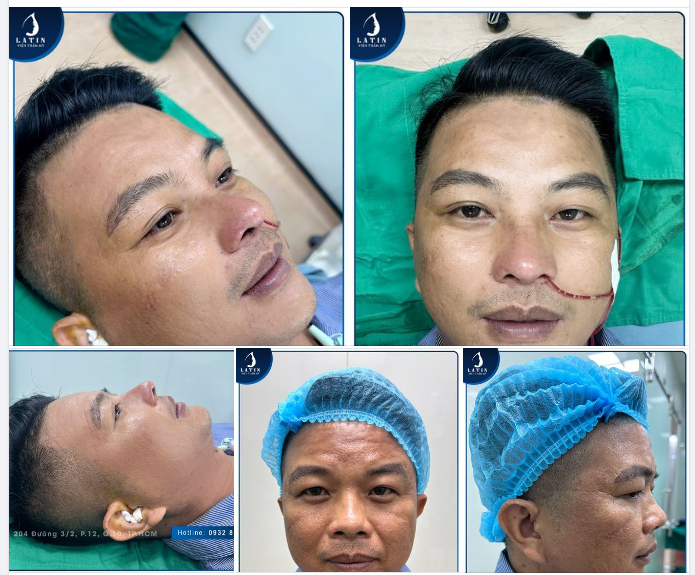 Công thức tạo nên hotboy nhà Latin. COMBO Mũi cấu trúc + Cắt mắt 4D + Độn cằm sụn Mỹ