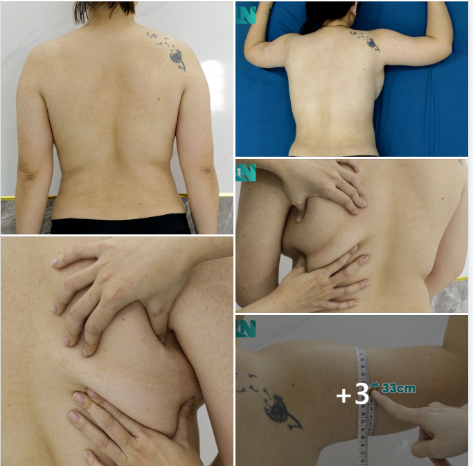 NỖI KHỔ KHI CƠ THỂ SỒ SỀ, DÁNG VÓC NHIỀU MỠ THỪA VÙNG TAY - LƯNG - NÁCH KHÓ MÀ CẢI THIỆN BẰNG PHƯƠNG PHÁP ĂN KIÊNG - TẬP LUYỆN THÔNG THƯỜNG!