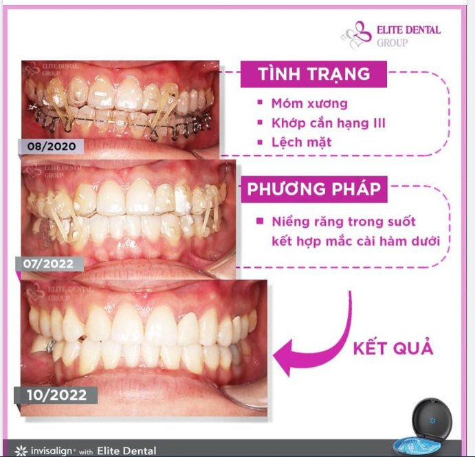 NIỀNG RĂNG TRONG SUỐT KẾT HỢP MẮC CÀI HÀM DƯỚI