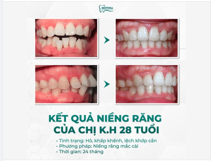 NIỀNG RĂNG MẮC CÀI: SỰ THAY ĐỔI RÕ RỆT