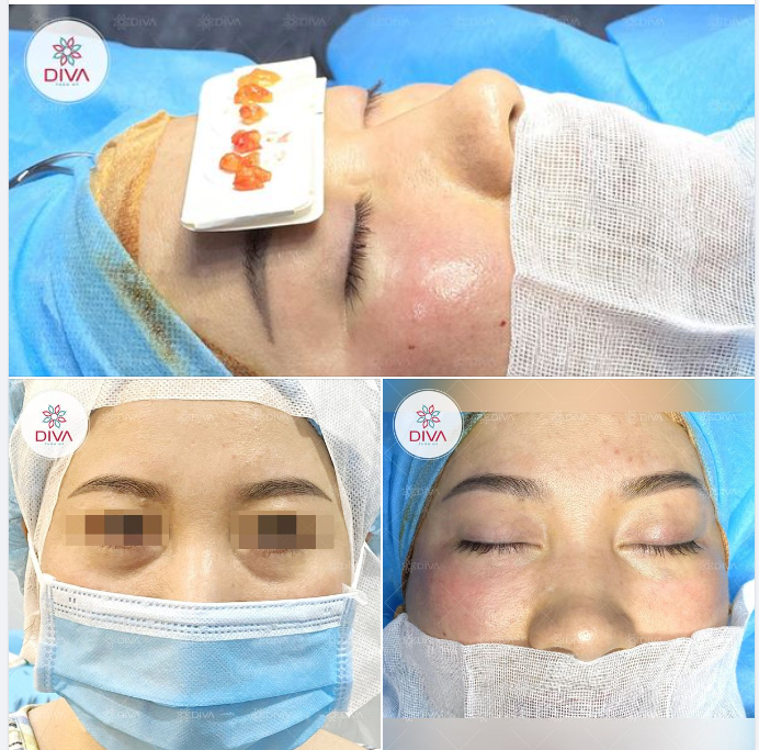 ĐẨY LÙI LÃO HÓA, TRẺ HÓA VÙNG MẮT VỚI LẤY TÚI MỠ MẮT DƯỚI