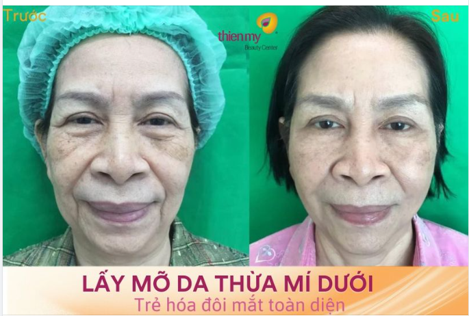U60 trẻ thêm 5 tuổi nhờ thực hiện dịch vụ lấy mỡ da thừa mí dưới.