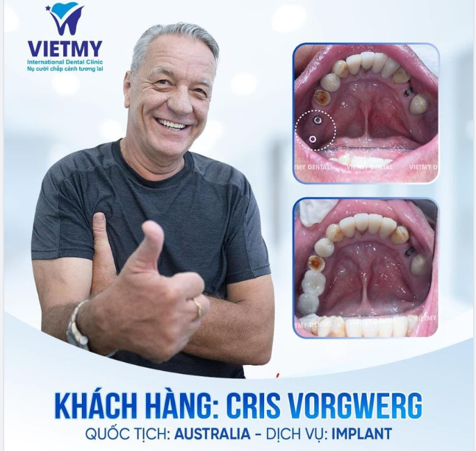 HOÀN TẤT CẤY GHÉP IMPLANT CHO VỊ KHÁCH NGOẠI QUỐC VUI TÍNH