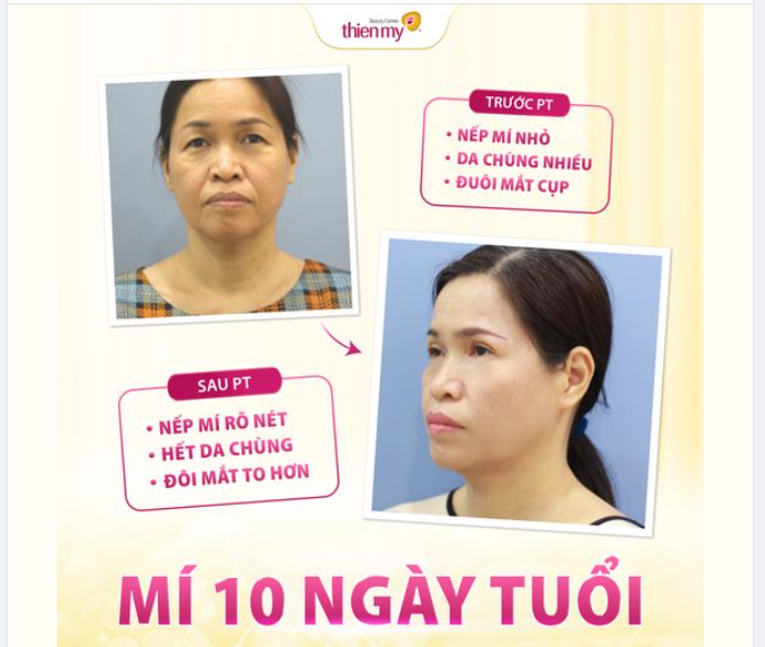 CẮT MÍ AN TOÀN – MẮT ĐẸP TOÀN DIỆN | ưu đãi còn 7,9tr