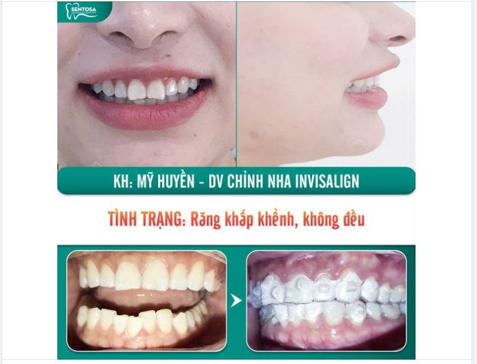 INVISALIGN: CẢ MỘT QUÁ TRÌNH ĐỂ TÌM NỤ CƯỜI CHO CHÍNH MÌNH