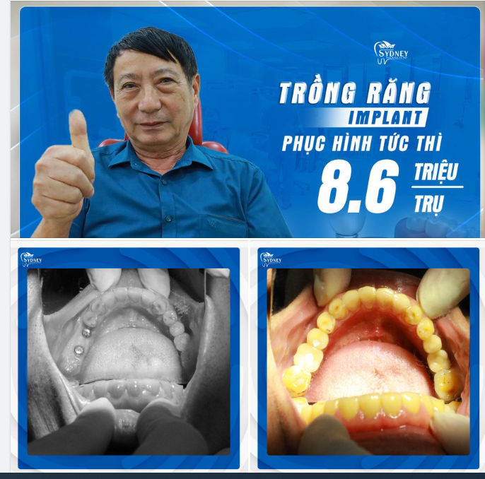 CÓ THỂ BẠN CHƯA BIẾT VỀ TRỒNG RĂNG IMPLANT TỨC THÌ?