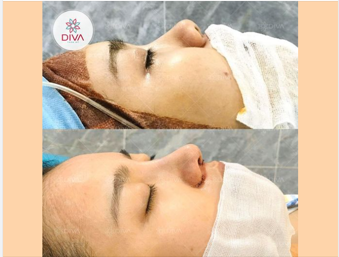 KẾT QUẢ THẨM MỸ SAU NÂNG MŨI SLINE SỤN TỰ THÂN