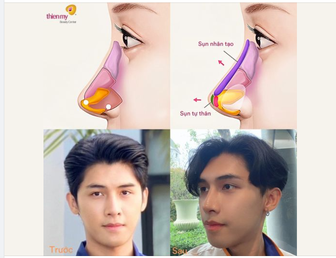 ĐẰNG SAU CÂU CHUYỆN NÂNG MŨI CỦA KH NAM