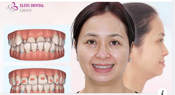 Khớp cắn ngược: Niềng răng khay trong suốt có hiệu quả không?