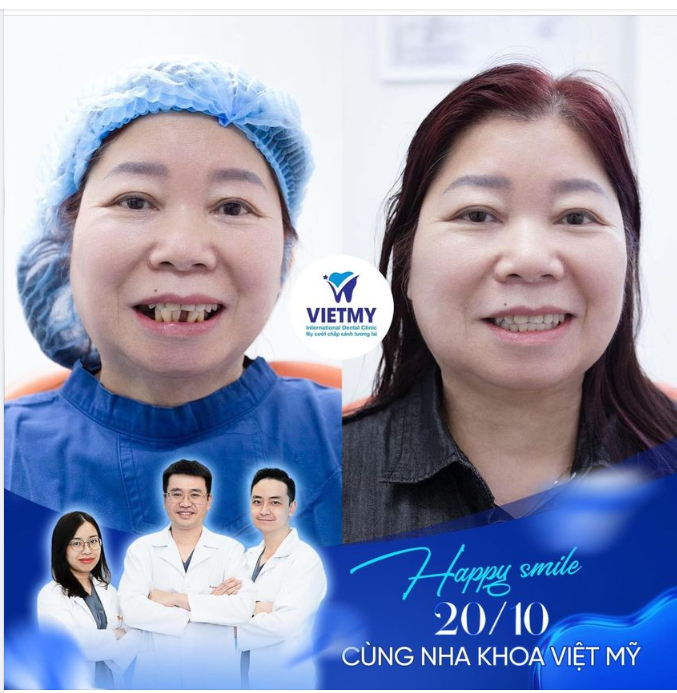 IMPLANT PHỤC HÌNH THÀNH CÔNG CHO NỮ KHÁCH HÀNG VIỆT KIỀU ĐỨC 