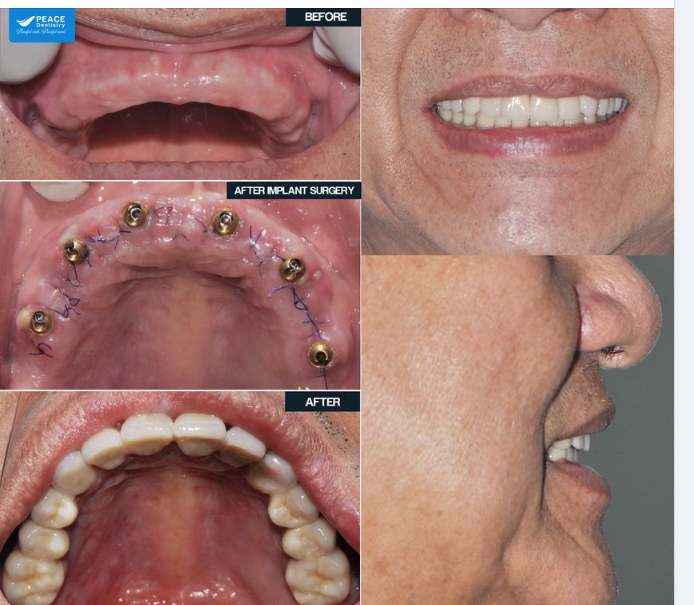Trồng răng implant với  người lớn tuổi không chỉ là vấn đề ăn nhai mà còn là sức khỏe toàn thân, tinh thần, sự trẻ trung và chất lượng cuộc sống.